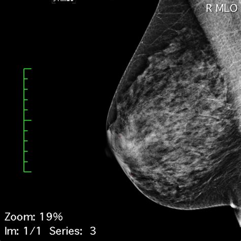 Breast Micro-Calcifications Dataset | Kaggle