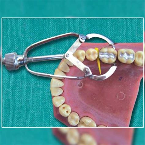 Waldent Matrix Retainer - Ivory No. 1 (8/106) – Waldent.com