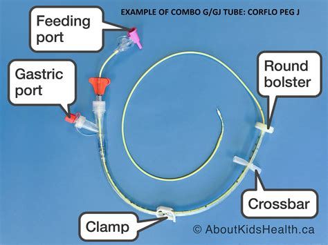 Different Types Of Enteral Feeding Tubes at Jeremy Nilsson blog