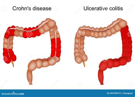 Enfermedad Inflamatoria Intestinal. Intestino Grueso. Enfermedad De Crohn Y Colitis Ulcerosa ...
