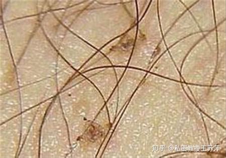 长了阴虱虫内裤的图片有阴虱的内裤是怎样的2022已更新今日资讯