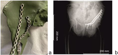 Fast-Track-Protocol for Optimization of Presurgical Planning in Acute ...