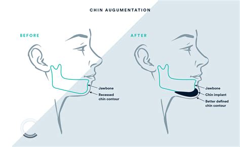 Chin Implant London | Chin Augmentation UK Price, Cost & Finance