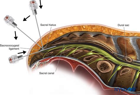 What Is The Definition Of Caudal Block at Deidra Mckoy blog