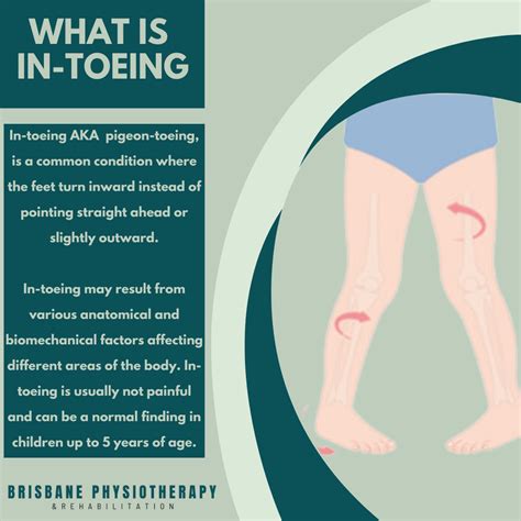 What is In-Toeing? - Brisbane Physiotherapy & Podiatry