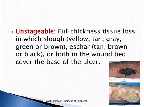 Pressure ulcers presentation | PPSX