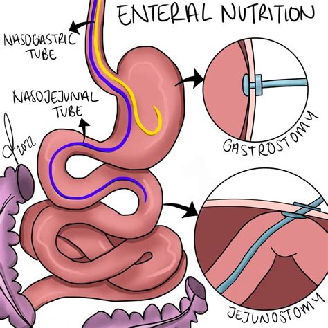 Types Of Enteral Nutrition Tubes at Cody Osborne blog