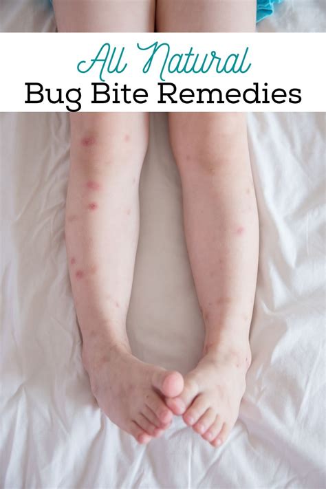 insect bites natural remedies