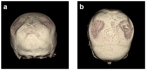 Long-Term Comparison of Two- and Three-Dimensional Computed Tomography ...