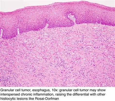 Pathology Outlines - Granular cell tumor
