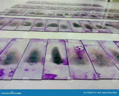 Stained Glass Slides of Peripheral Blood Smear with Violet Leishman Giemsa Stain is Isolated in ...