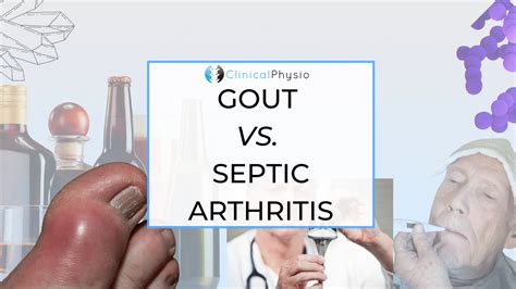 Gout versus Septic Arthritis – Clinical Physio Membership