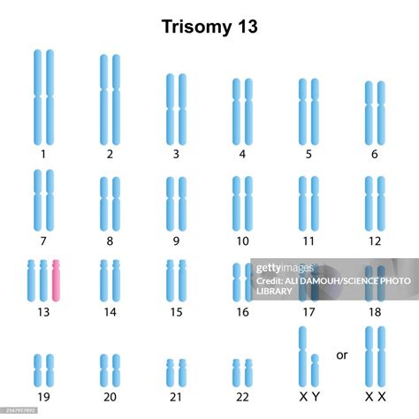 Trisomy 13 Syndrome Illustration High-Res Vector Graphic - Getty Images