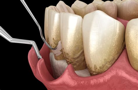重度牙周病一定要拔牙么？牙槽骨严重吸收，还能种牙么？