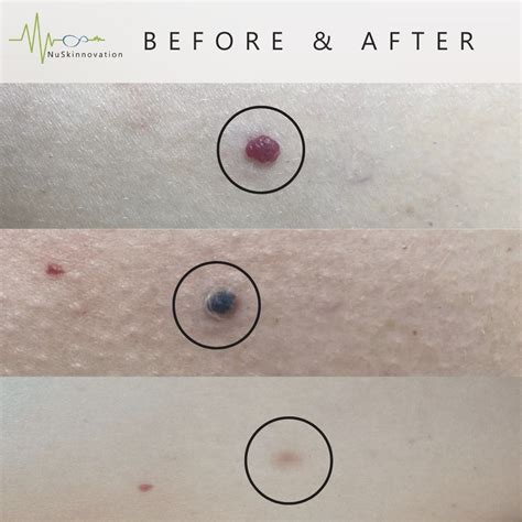 How To Remove Cherry Angiomas