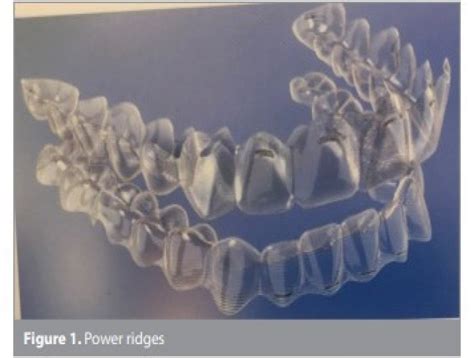 CLEAR ALIGNERS | Saraswati Dental College & Hospital