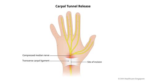 Carpal Tunnel Release | Mount Elizabeth Hospitals