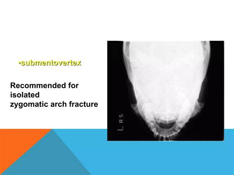 Management of zygomaticomaxillary complex fractures ih | PPTX