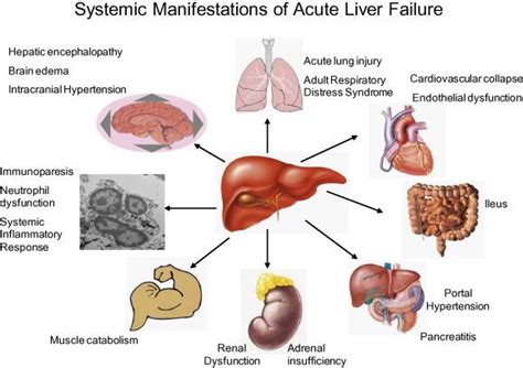 Acute or Fulminant Liver Failure | Dr Rahul Saxena - Liver Transplant ...