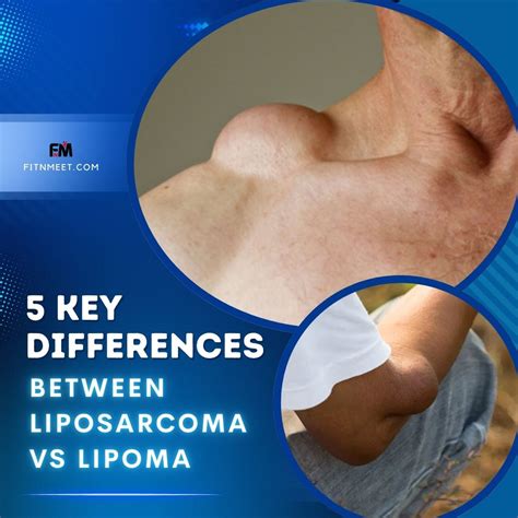 5 Key Differences Between Liposarcoma vs Lipoma - FitnMeet