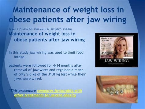 Wiring A Jaw Shut at Margaret Burgin blog