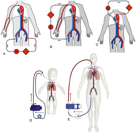 Extracorporeal membrane oxygenation (venovenous and venoarterial ECMO ...