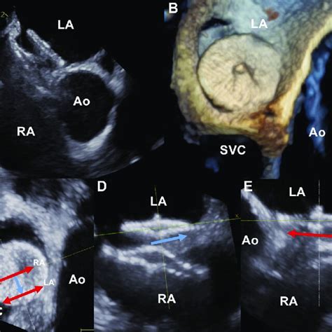 PFO Defect 的图像结果