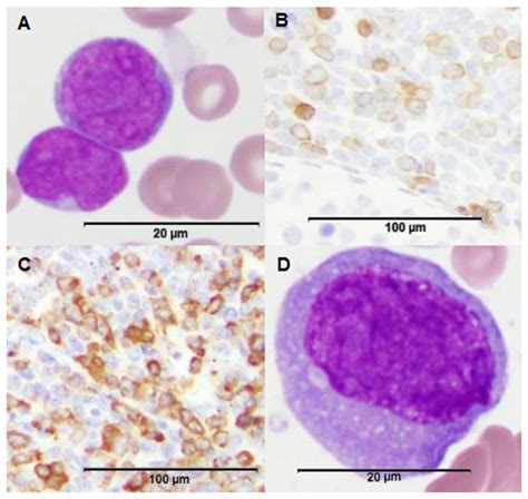 Acute Lymphoblastic Leukemia