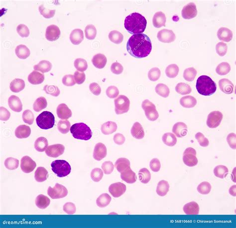 Leucemia Linfoblástica Aguda (TODA) Foto de archivo - Imagen de leucocito, desprestigio: 56810660