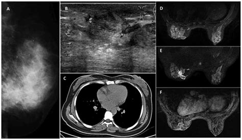 Fat Necrosis Breast Ultrasound