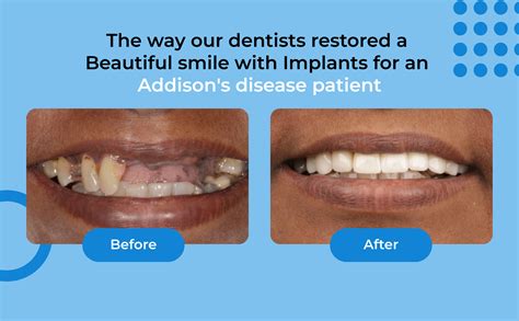 Smile restoration with implants for an Addison's disease patient