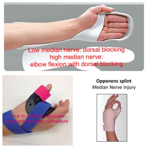 Median Nerve Injury Splint Recovering From Carpal Tunnel Surgery