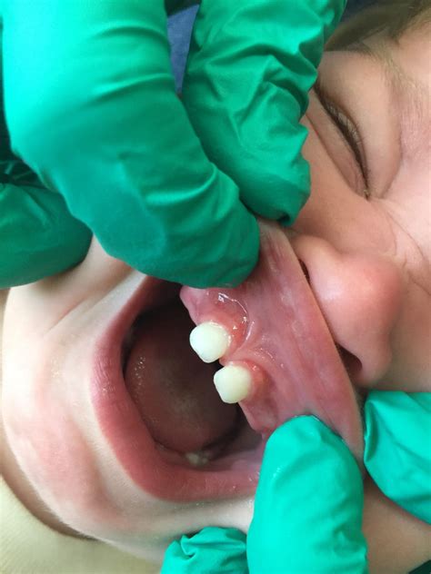 Lip Tie Procedure: What to Expect with a Frenectomy