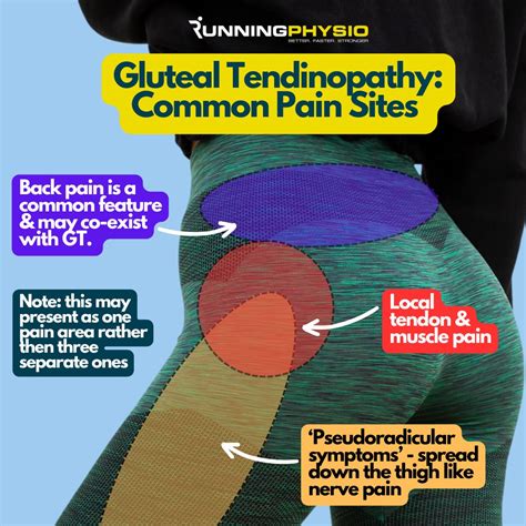 Do you have a pain in your Butt? A pang in your Posterior? | The Jersey Sports & Spinal Clinic