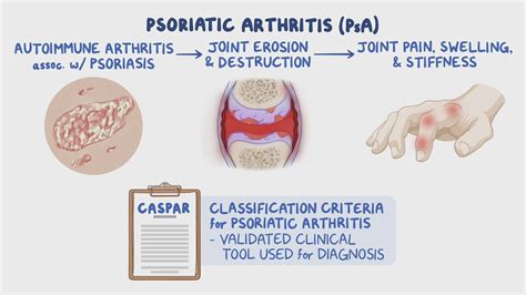 Video: Psoriatic arthritis: Clinical sciences | Osmosis