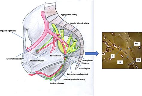 The minimally invasive sacrospinous fixation under visual guidance: An ...