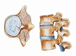 Image result for Stenosis