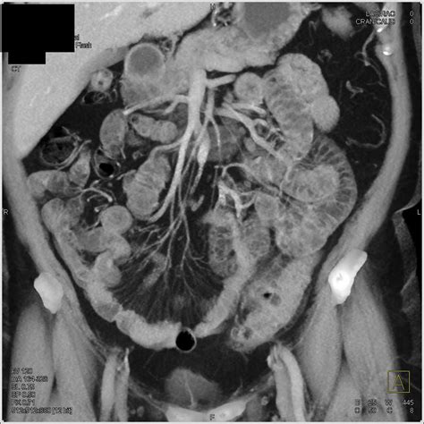 Diverticulitis Sigmoid Colon - Colon Radiology Case Studies - CTisus CT ...