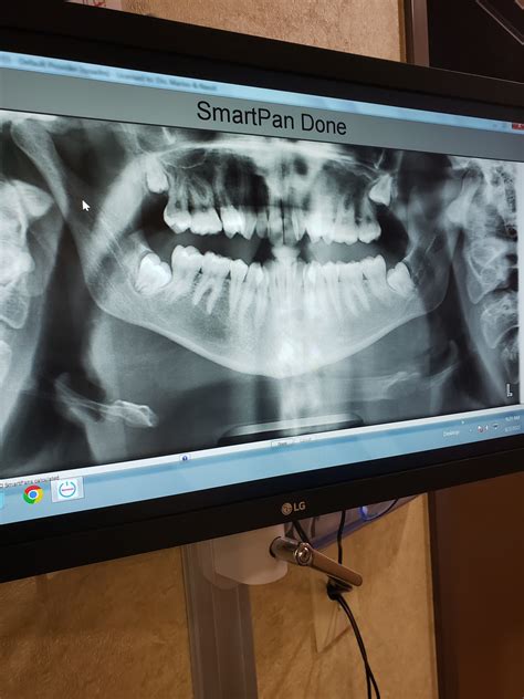 My Wisdom Teeth X-Ray! : r/XRayPorn