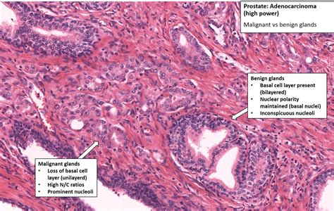 Prostate – Prostatic Carcinoma – NUS Pathweb :: NUS Pathweb