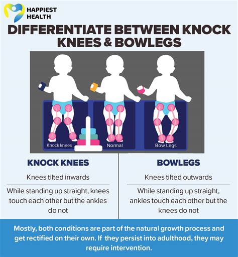 Bowlegs vs Knock Knees