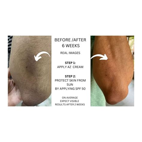 PanahLabs Skin Brightening Cream with 10% Azelaic Acid - India | Ubuy