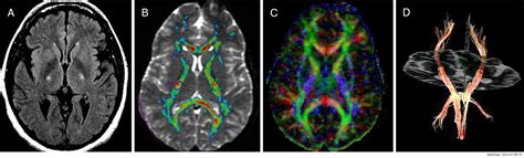 Diagnóstico de la esclerosis lateral amiotrófica: avances en RM ...