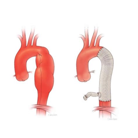 Thoracic Aortic Aneurysm Classification