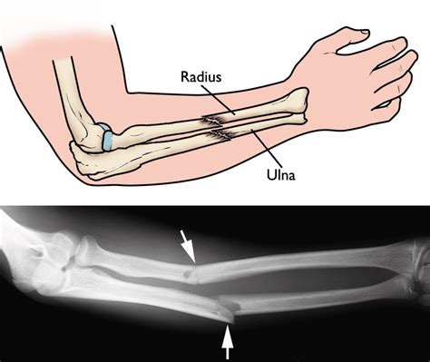 Radius Fracture 的图像结果