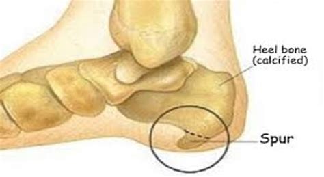 DIAPRO Specialized Footwear For Calcaneal Spur - Health, Beauty ...