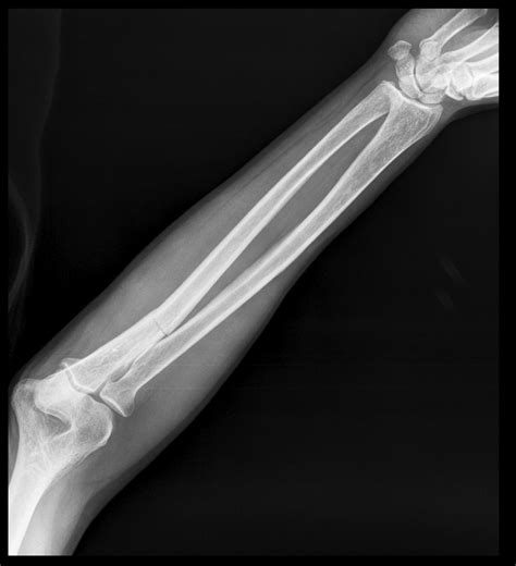 Ulna Bone Xray