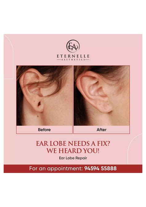 Ear Lobe Repair procedure eternell aesthetics.pdf
