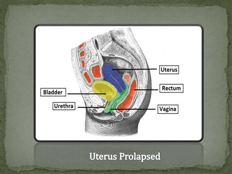 Uterine Prolapse