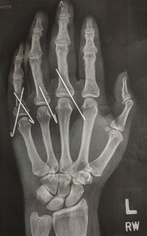 Broken Index Finger X Ray